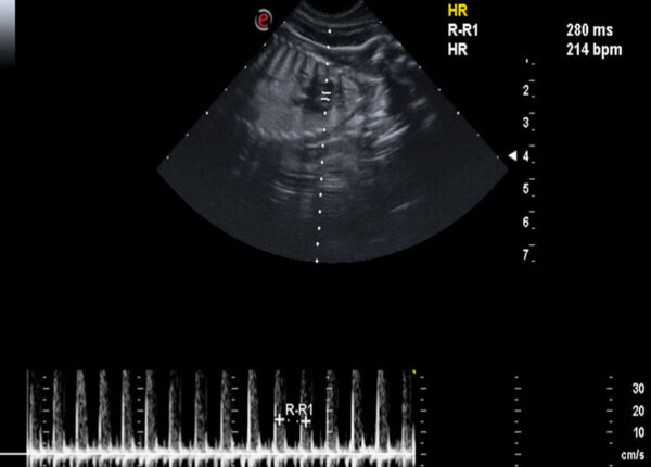 PREGNANCY ULTRASOUND