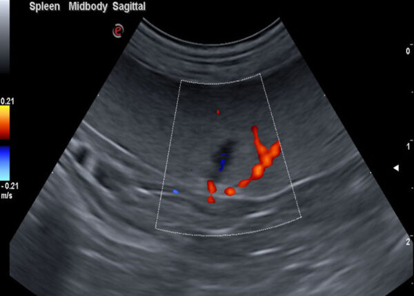 ABDOMINAL ULTRASOUND